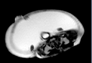 Imagerie de la pathologie testiculaire de l’enfant