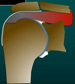 Radiologie pratique de l'espace sous-acromial & Aspect radiologique des dépôts microcristallins