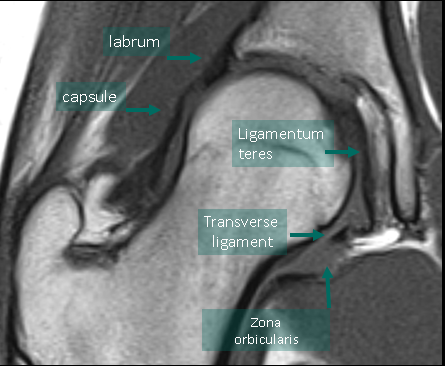 Hanche - anatomie, variante, coxarthrose, prothèse