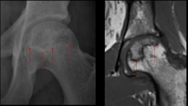 Hanche et autour  ONTF, conflit, pathologie du sportif