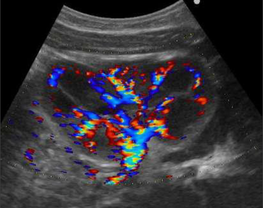 Imagerie des infections urinaires et du reflux vésico-urétéral