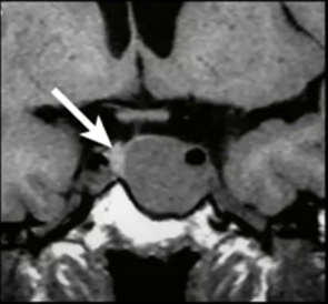 IRM des pathologies hypophysaires