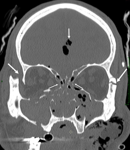 Anatomie et pathologie de l’orbite