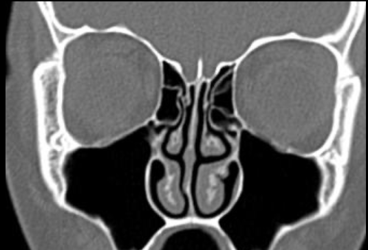 Anatomie et pathologie sinusienne