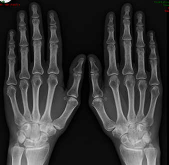 Rhumato : PR, psoriasis, PPR