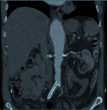 Interventions aortiques et des troncs digestifs