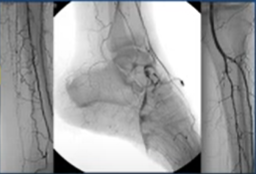 Recanalization of infra popliteal CTO + US Doppler et insuffisance veineuse