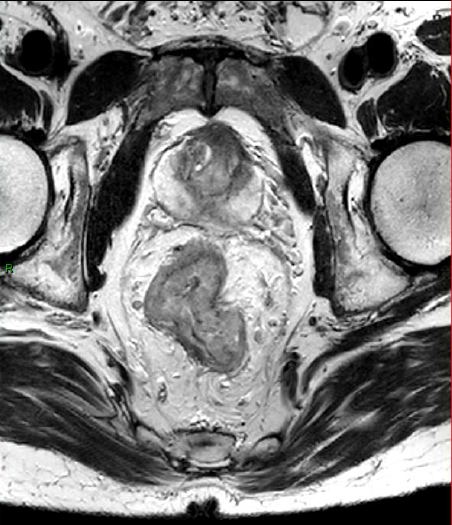 Le cancer du rectum