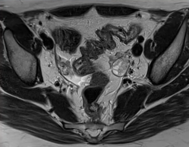 Pelvis : Caractérisation des masses annexielles de l'abdomen aigu à l'incidentalome