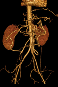 L’essentiel sur l’ischémie intestinale aiguë en imagerie