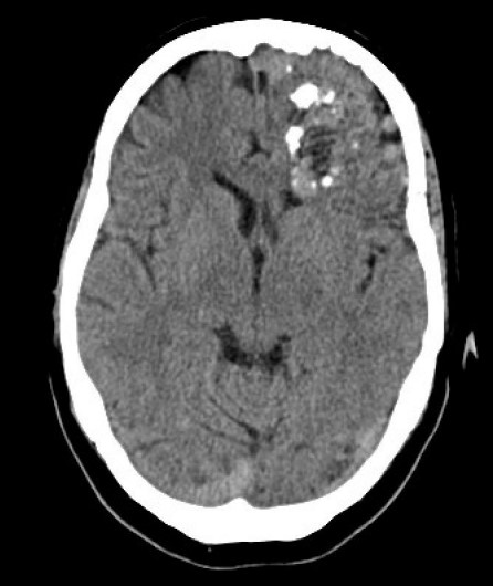 Lésions vasculaires (MAV-fistules-Moya-Moya) cérébrales et médullaires